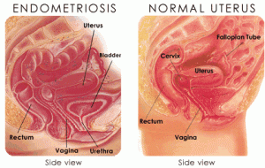 con_education_endometriosis